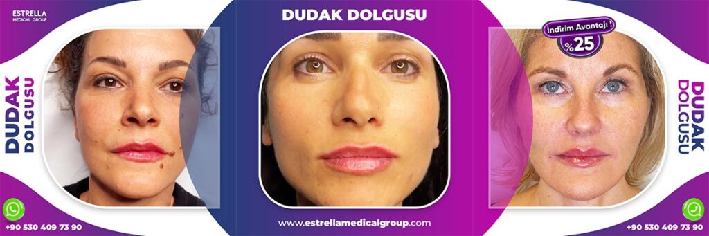 dudak dolgusu işlemi