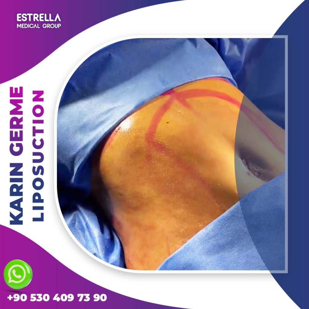 karın germe liposuction