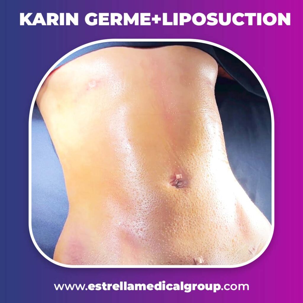 karın germe liposuction